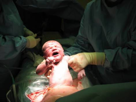 Neonato tirato fuori durante un parto cesareo