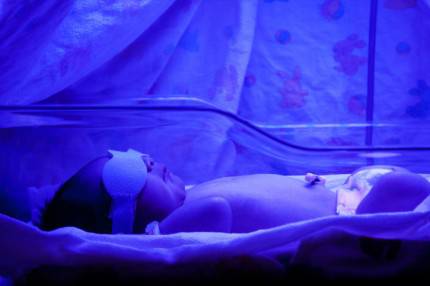 Neonato affetto da ittero sotto lampada UV