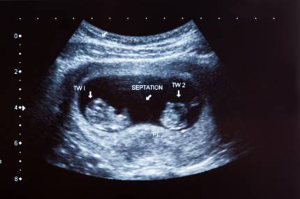 ecografia di una gravidanza gemellare