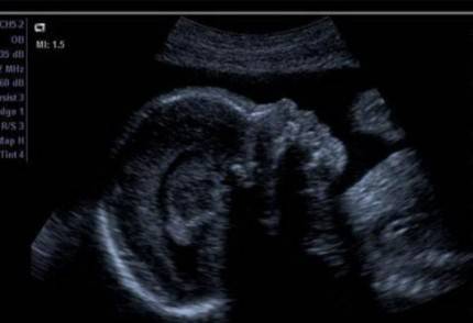 Immagine ecografica della testa di un feto
