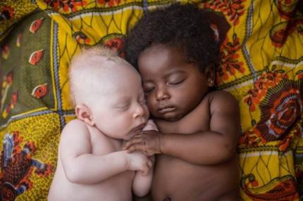 neonato albino in africa