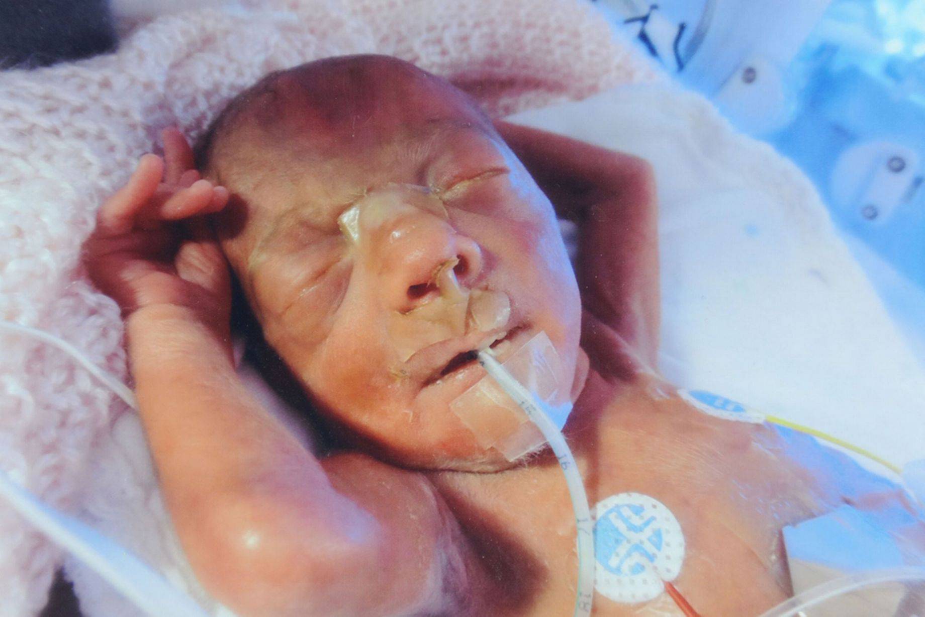 bambina prematura appena nata