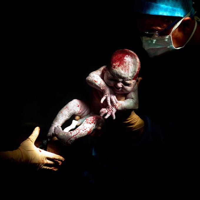 neonato appena estratto grembo