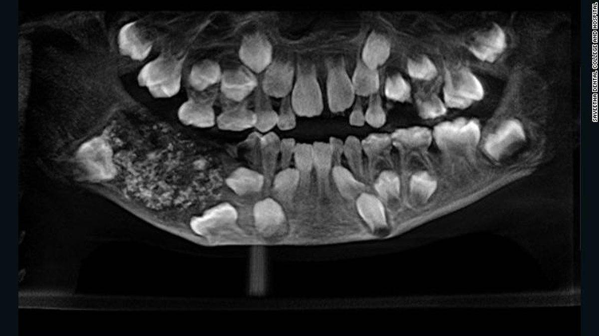 Bambino con 500 denti