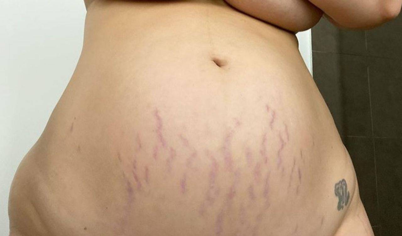 растяжки на груди при беременности как избавиться фото 108